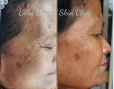 Deep Sea peel Before and After